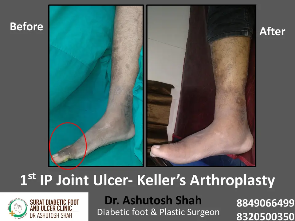 Diabetic Foot  PPT 3 checked by sir.pptx-75.webp